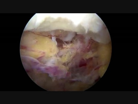 Estenosis raquídea lumbar