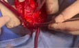 Homoinjerto pulmonar de paciente con DCD para reconstrucción del tracto de salida del ventrículo derecho
