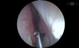Septoplastia Endoscópica