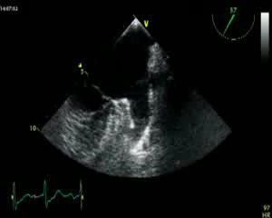 Trombo en la orejuela auricular izquierda