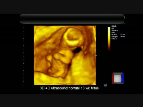 3D 4D ultrasonido - feto normal de 13 semanas