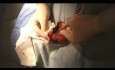 Vasectomía sin bisturí ni suturas