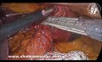 Resección laparoscópica de tumores del estroma gastrointestinal (GIST)