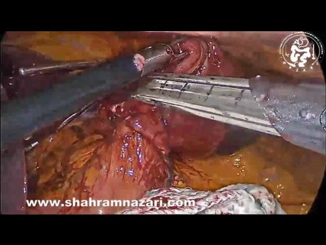 Resección laparoscópica de tumores del estroma gastrointestinal (GIST)