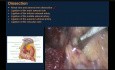 Adrenalectomía izquierda laparoscópica para feocromocitoma grande con pasos quirúrgicos