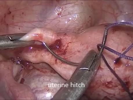 Anastomosis uterovaginal laparoscópica para agenesia cervical