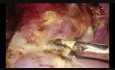 Histerectomía ambulatoria