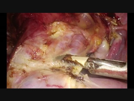 Histerectomía ambulatoria