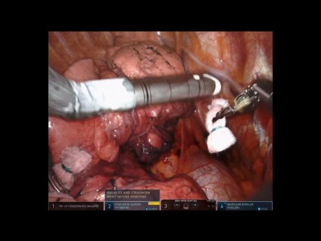 Lobectomía media robótica de pulmón