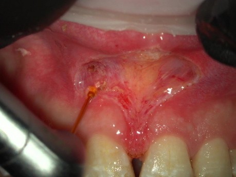 Apicectomía con láser de erbio sin suturas