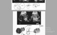 Teratoma Cervical Fetal Diagnostico Ecografico Prenatal