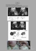 Teratoma Cervical Fetal Diagnostico Ecografico Prenatal