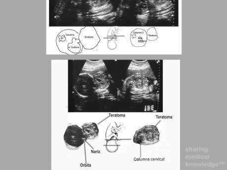 Teratoma Cervical Fetal Diagnostico Ecografico Prenatal