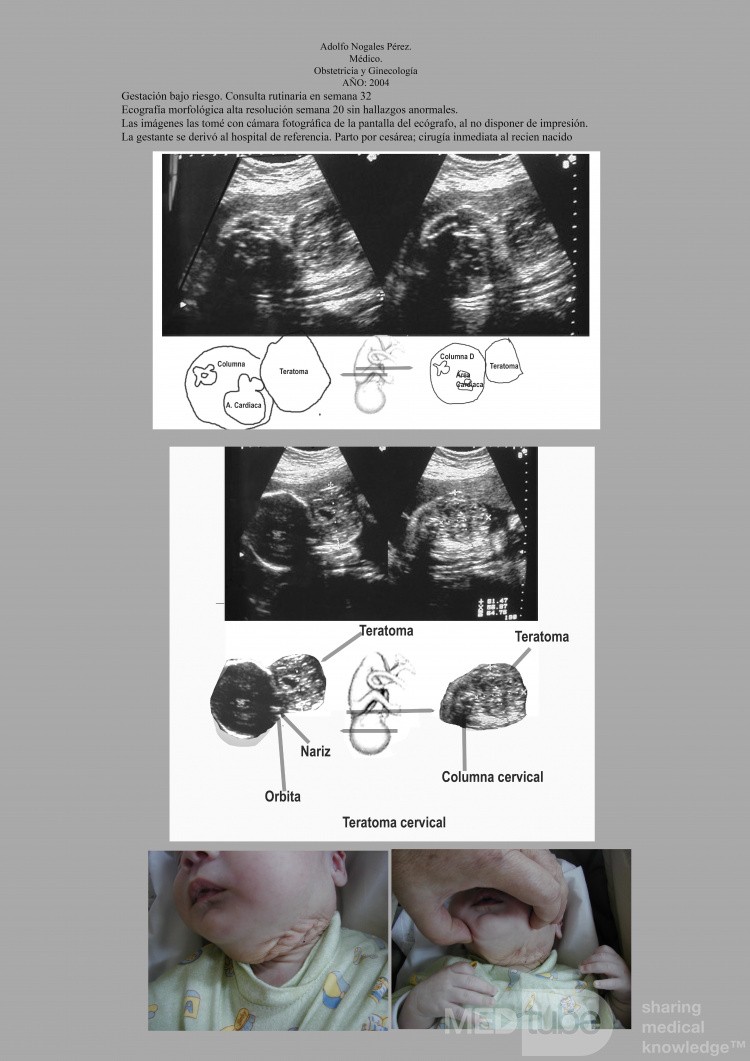 Teratoma Cervical Fetal Diagnostico Ecografico Prenatal