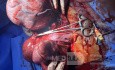 Huge Leiomyoma Uteri