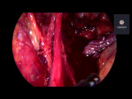 Resección en bloque del compartimento posterior de la endometriosis profunda