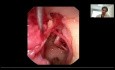 Anatomía endoscópica del oído