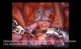 Lobectomía superior derecha pulmonar robótica, sin editar - FÁCIL