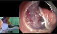 Disección submucosa endoscópica (DSE) de adenoma rectal - Dr. Makot Nishimura