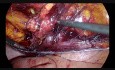 Preperitoneal transabdominal laparoscópica para hernia inguinal encarcelada