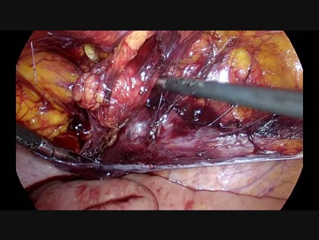 Preperitoneal transabdominal laparoscópica para hernia inguinal encarcelada