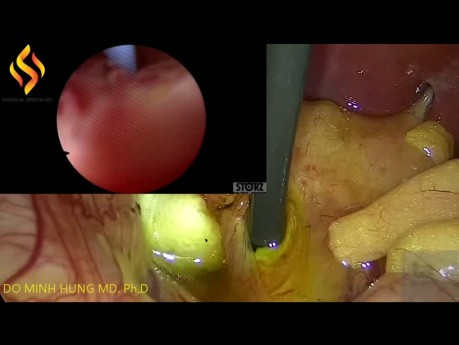 Colecistectomía laparoscópica y coledoctomía de cálculos