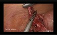 Intervención laparoscópica del muñon apendicular
