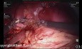 Resekcja dużej torbieli dróg żółciowych z użyciem robota/laparoskopowa