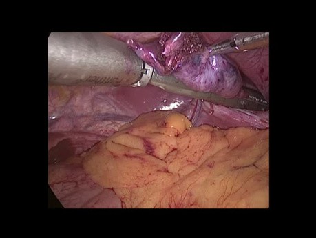Plicatura diafragmatica por laparoscopia