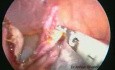 Cistectomía ovárica laparoscópica