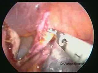 Cistectomía ovárica laparoscópica