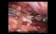 Tumor mediastínico