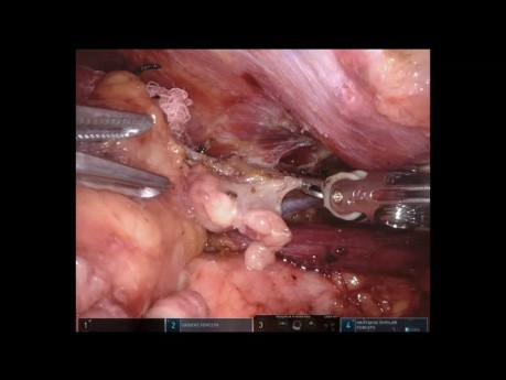 Tumor mediastínico