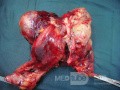 Obstrucción del intestino delgado por linfoma no Hodgkin 1