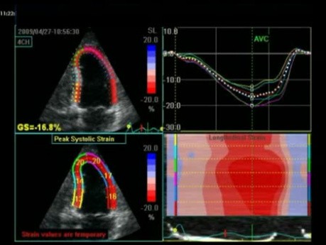 Ecocardiograma con Dobutamina