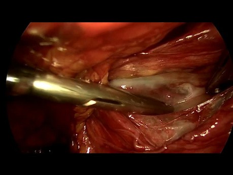  La técnica totalmente extraperitonenal laparoscópica sin uso de electrocoagulación