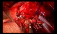 Anastomosis vascular Uniportal VATS con doble manga