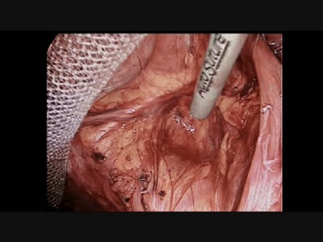 Reparación laparoscópica de hernia inguinal