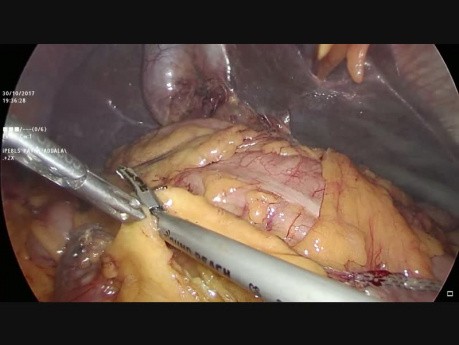 Hepaticoyeyunostomía laparoscópica