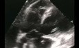 Un caso de embolia pulmonar con trombo en tránsito