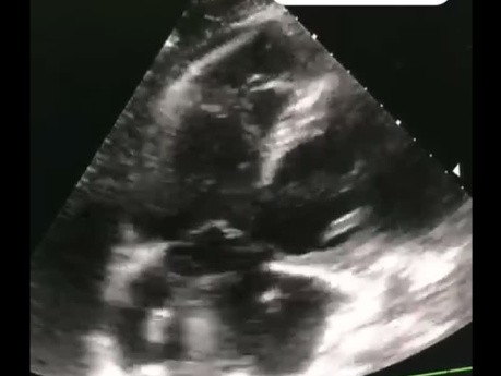 Un caso de embolia pulmonar con trombo en tránsito
