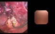 Colecistectomia laparoscopica + exploracion de vias biliares por coledoscopia