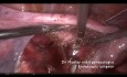 Laparoscopia para mioma uterino de ligamento ancho