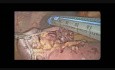 Resección laparoscópica de un GIST sangrante en el intestino delgado 