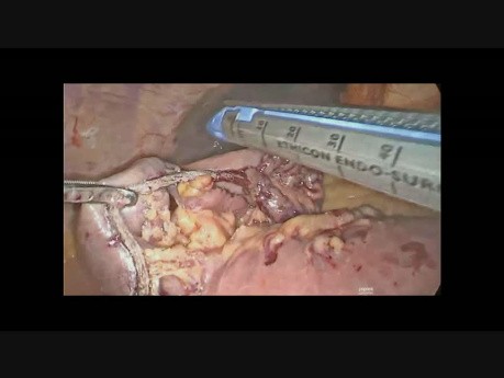 Resección laparoscópica de un GIST sangrante en el intestino delgado 