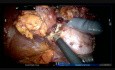 Resección robótica de tumores renales múltiples regulados 