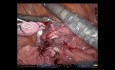 Biolobectomía asistida por robot para un tumor del lóbulo superior que invade el lóbulo medio