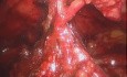 Retossigmoidectomía laparoscópica para adenocarcinoma de Haggit-IV