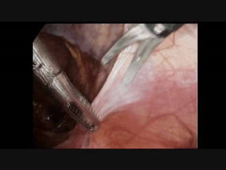 Reparación laparoscópica de hernia inguinal - paso 2 - incisión peritoneal derecha