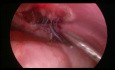 Reparación laparoscópica de la hernia de Morgagni retroesternal